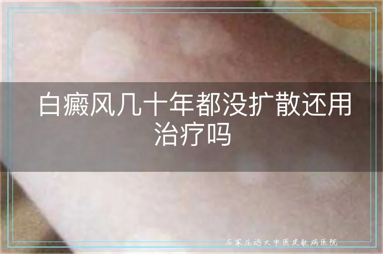 白癜风几十年都没扩散还用治疗吗