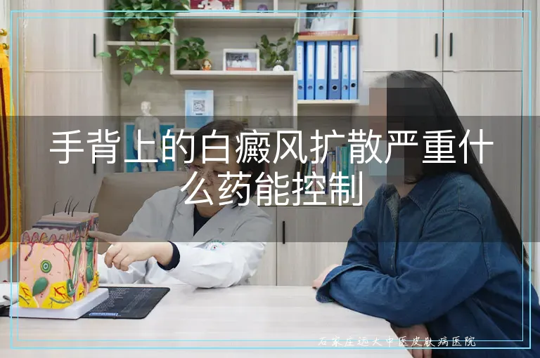 手背上的白癜风扩散严重什么药能控制