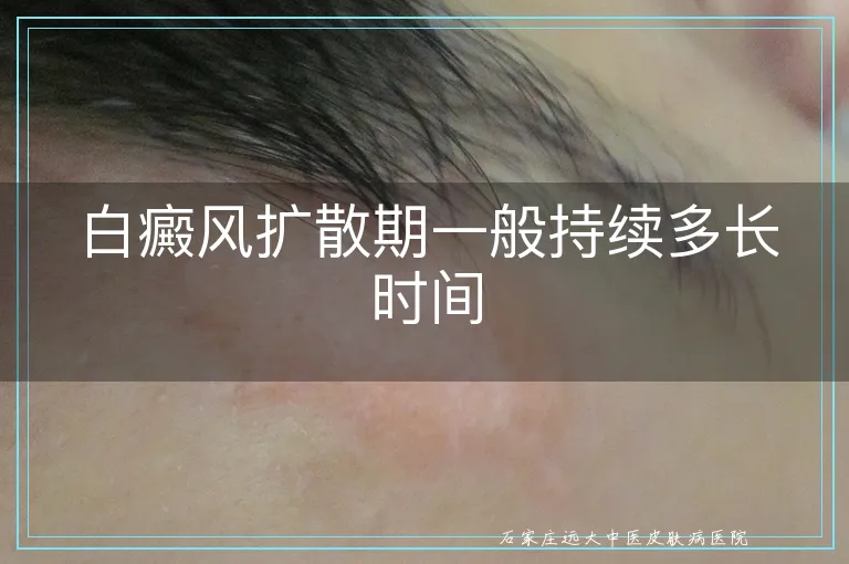 白癜风扩散期一般持续多长时间