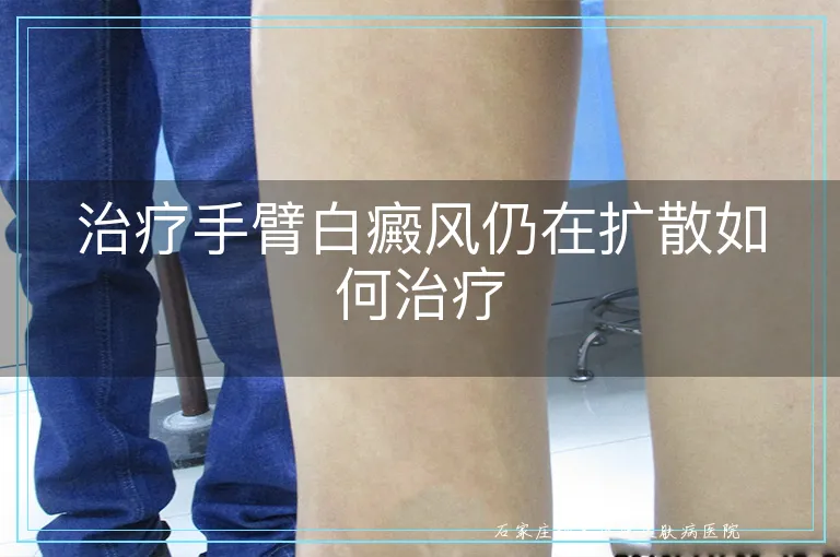 治疗手臂白癜风仍在扩散如何治疗
