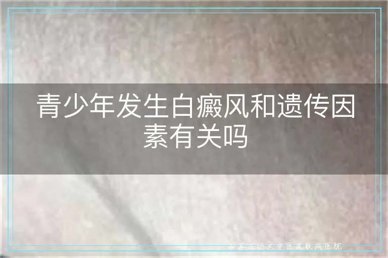 青少年发生白癜风和遗传因素有关吗
