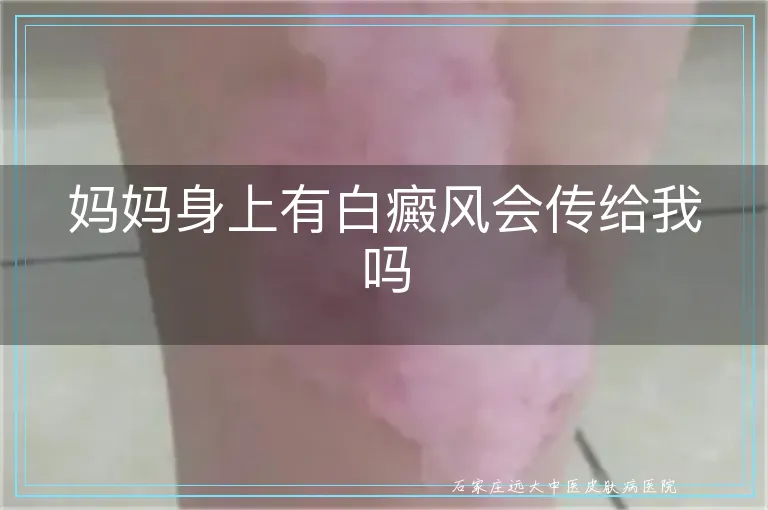 妈妈身上有白癜风会传给我吗