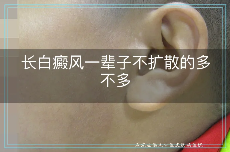 长白癜风一辈子不扩散的多不多