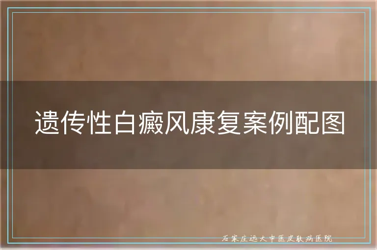 遗传性白癜风康复案例配图