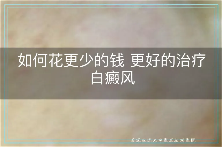如何花更少的钱 更好的治疗白癜风