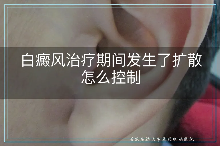 白癜风治疗期间发生了扩散怎么控制