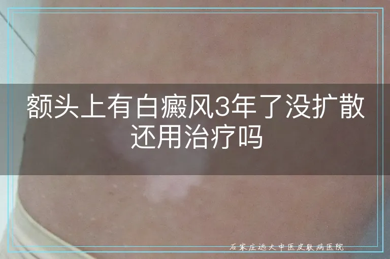 额头上有白癜风3年了没扩散还用治疗吗