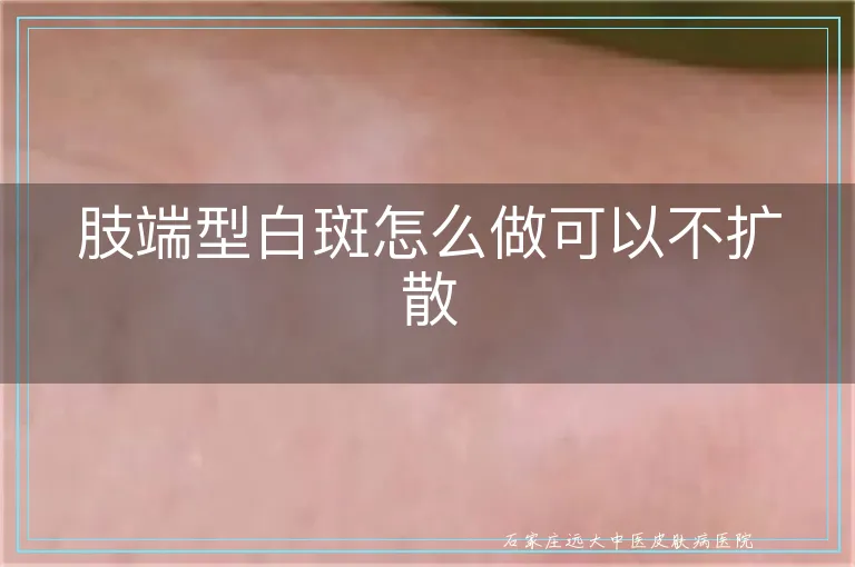 肢端型白斑怎么做可以不扩散