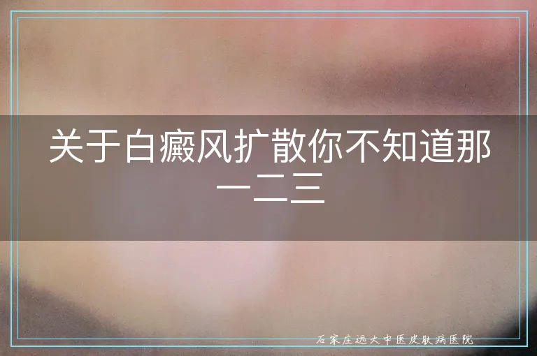 关于白癜风扩散你不知道那一二三