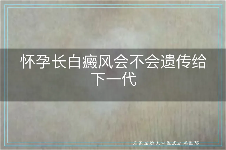 怀孕长白癜风会不会遗传给下一代