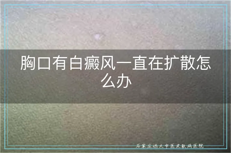 胸口有白癜风一直在扩散怎么办