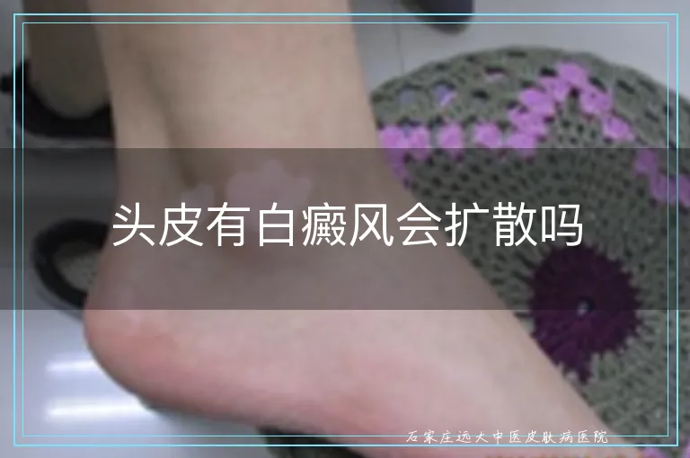 头皮有白癜风会扩散吗