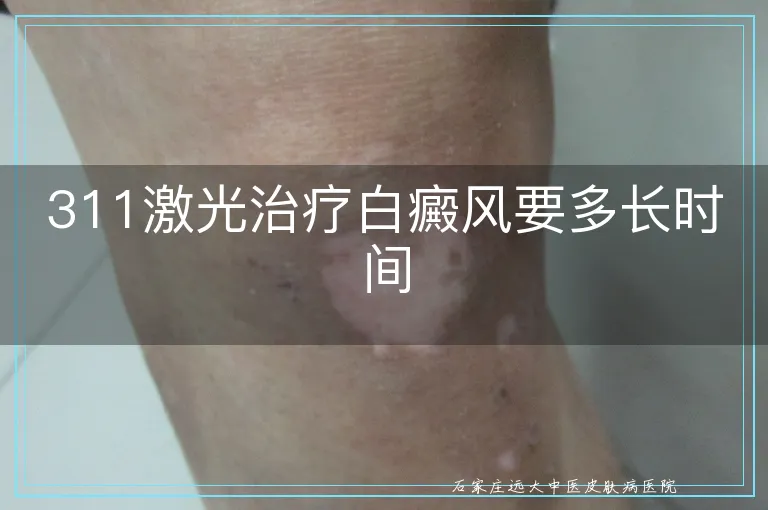 311激光治疗白癜风要多长时间