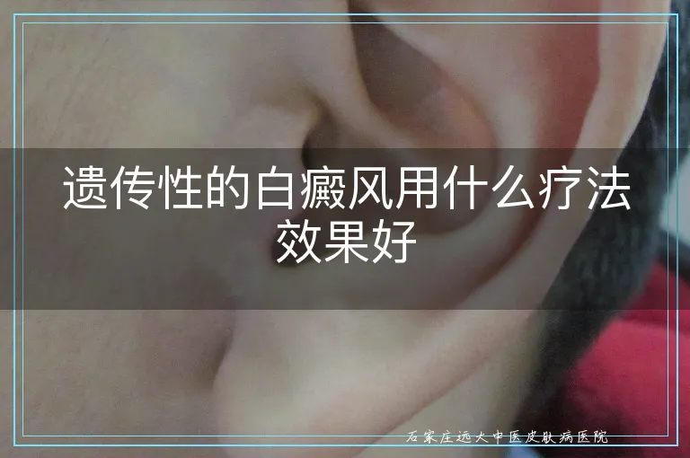 遗传性的白癜风用什么疗法效果好