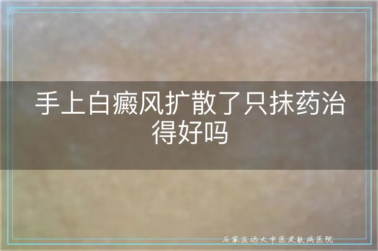 手上白癜风扩散了只抹药治得好吗
