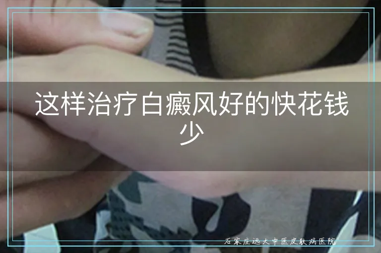 这样治疗白癜风好的快花钱少