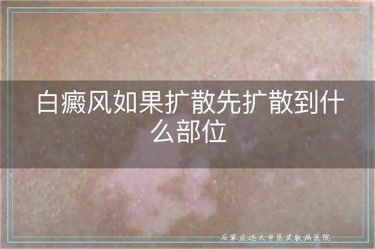 白癜风如果扩散先扩散到什么部位