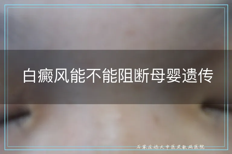 白癜风能不能阻断母婴遗传