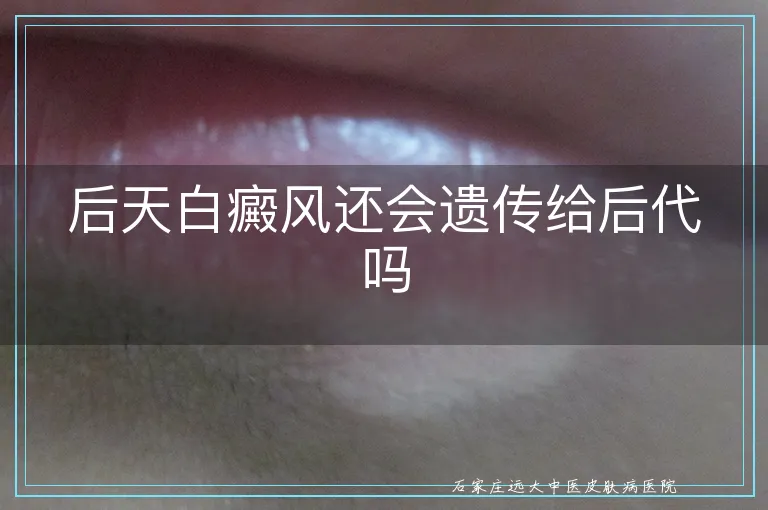 后天白癜风还会遗传给后代吗