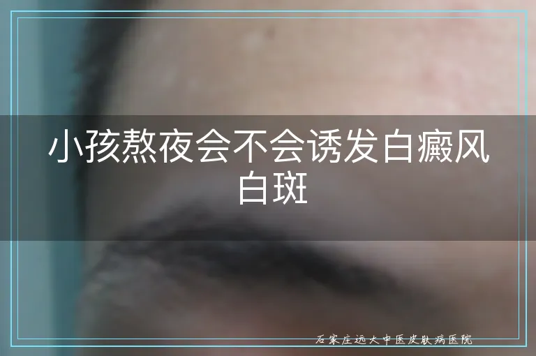 小孩熬夜会不会诱发白癜风白斑