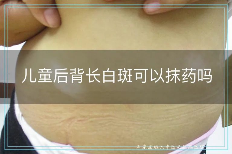儿童后背长白斑可以抹药吗