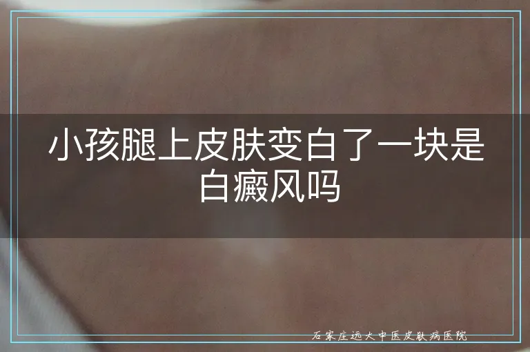 小孩腿上皮肤变白了一块是白癜风吗