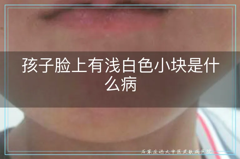 孩子脸上有浅白色小块是什么病