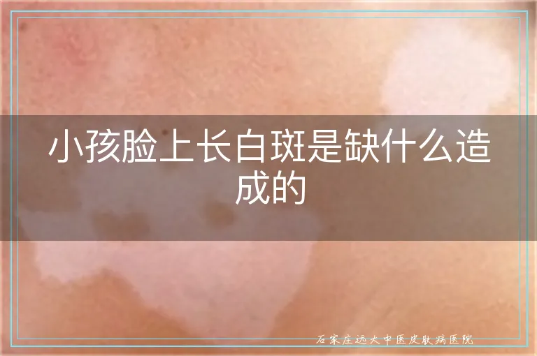小孩脸上长白斑是缺什么造成的