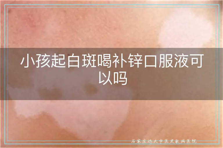 小孩起白斑喝补锌口服液可以吗