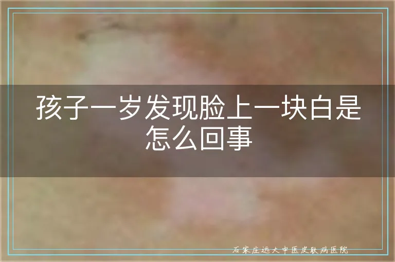 孩子一岁发现脸上一块白是怎么回事