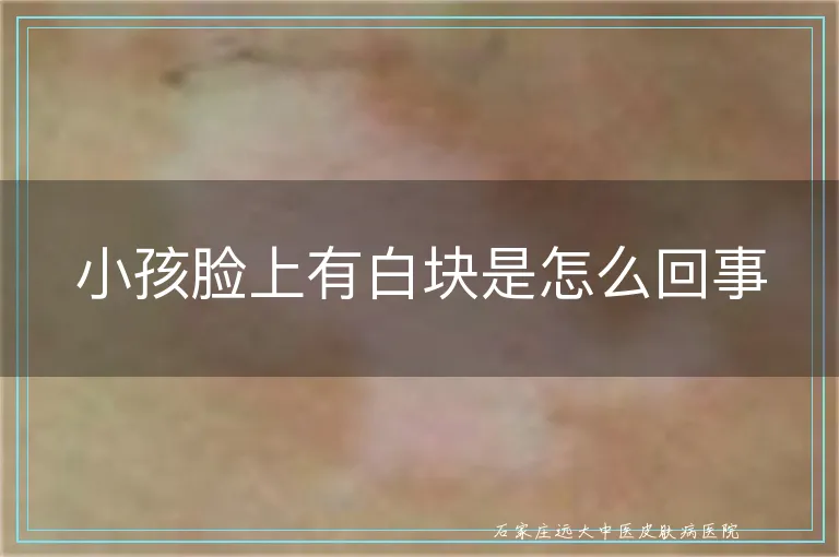 小孩脸上有白块是怎么回事