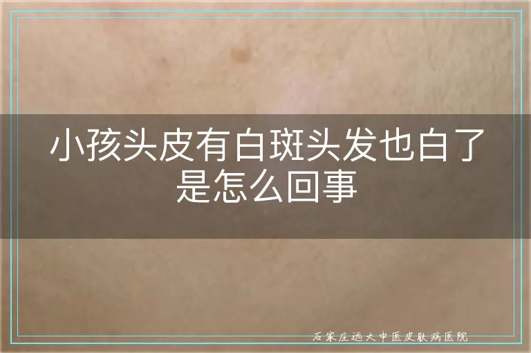 小孩头皮有白斑头发也白了是怎么回事