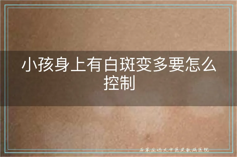 小孩身上有白斑变多要怎么控制