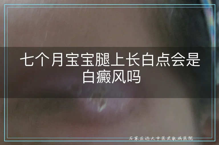 七个月宝宝腿上长白点会是白癜风吗