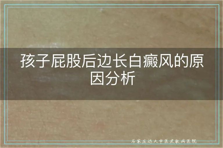 孩子屁股后边长白癜风的原因分析