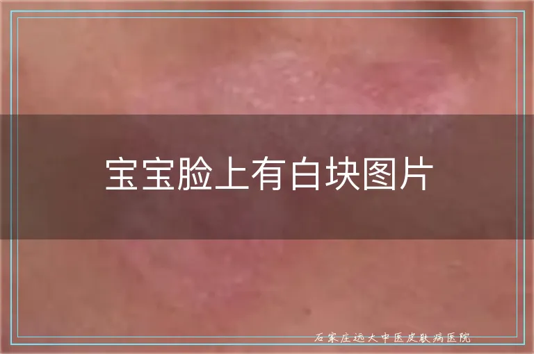 宝宝脸上有白块图片