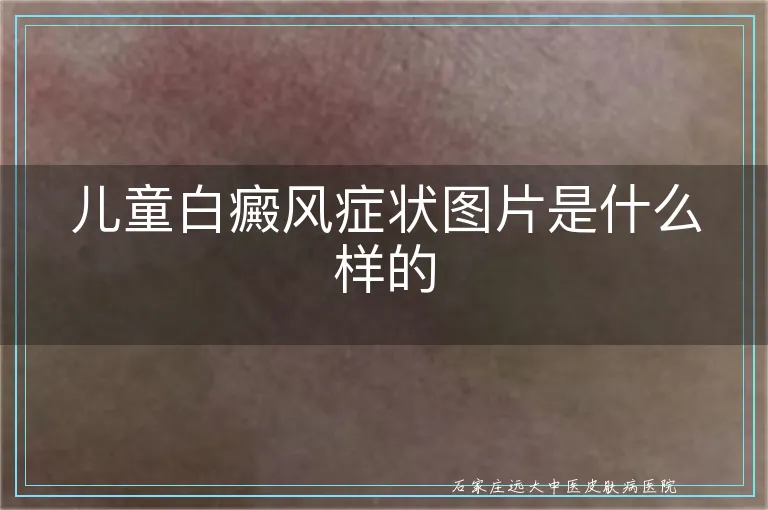 儿童白癜风症状图片是什么样的