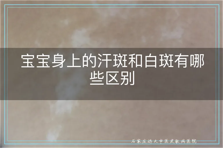 宝宝身上的汗斑和白斑有哪些区别