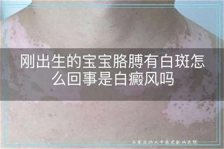 刚出生的宝宝胳膊有白斑怎么回事是白癜风吗