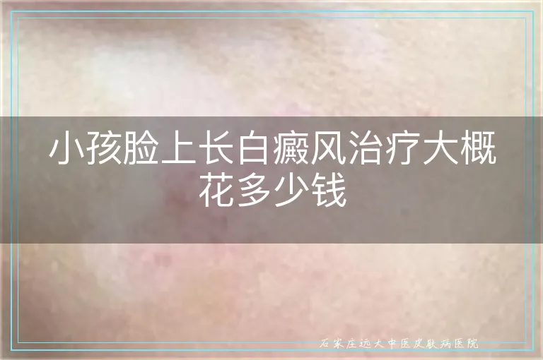小孩脸上长白癜风治疗大概花多少钱
