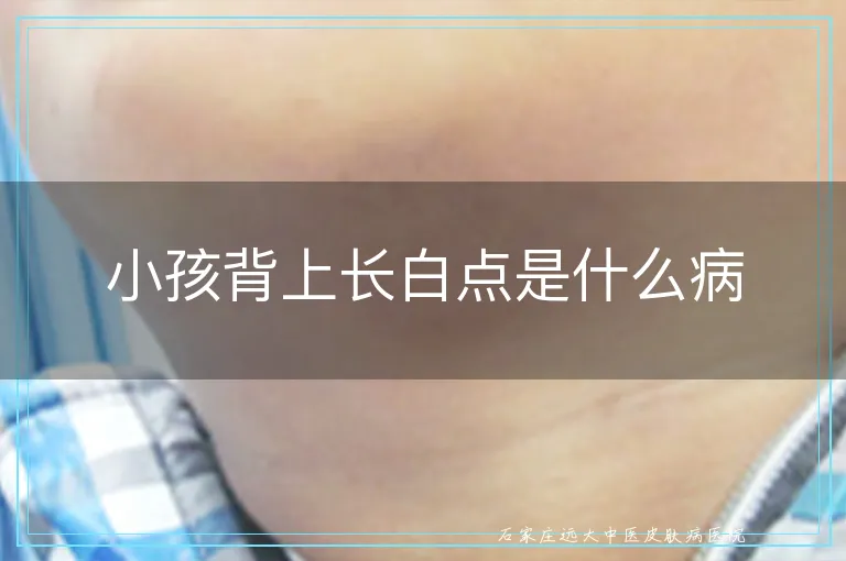 小孩背上长白点是什么病