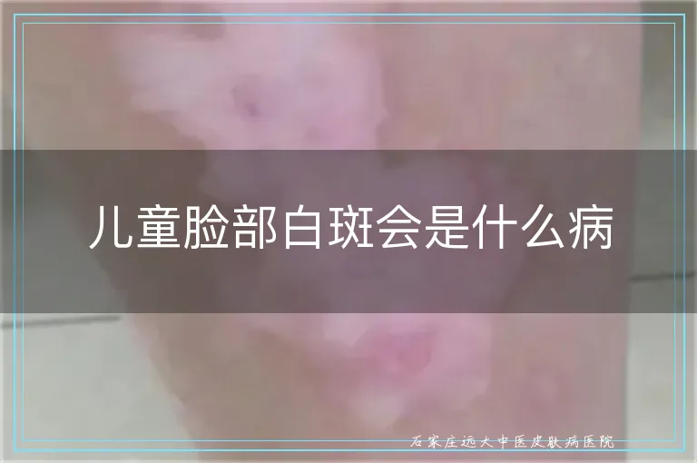 儿童脸部白斑会是什么病
