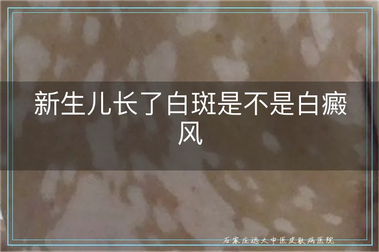 新生儿长了白斑是不是白癜风