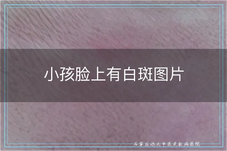 小孩脸上有白斑图片
