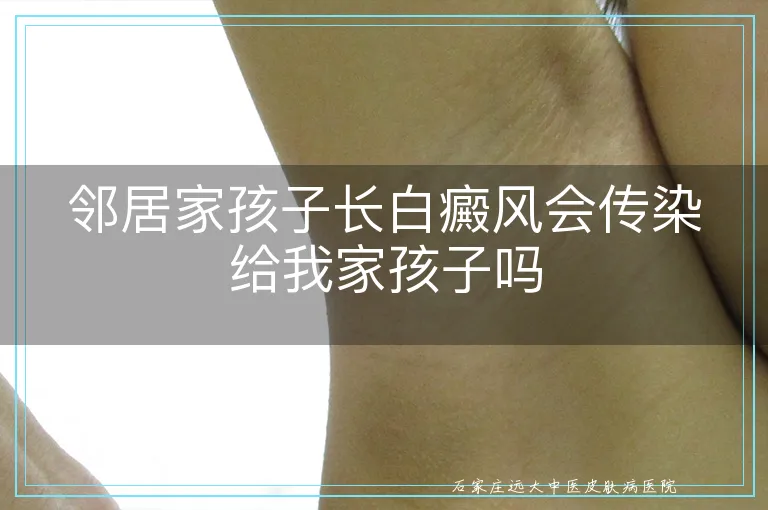 邻居家孩子长白癜风会传染给我家孩子吗