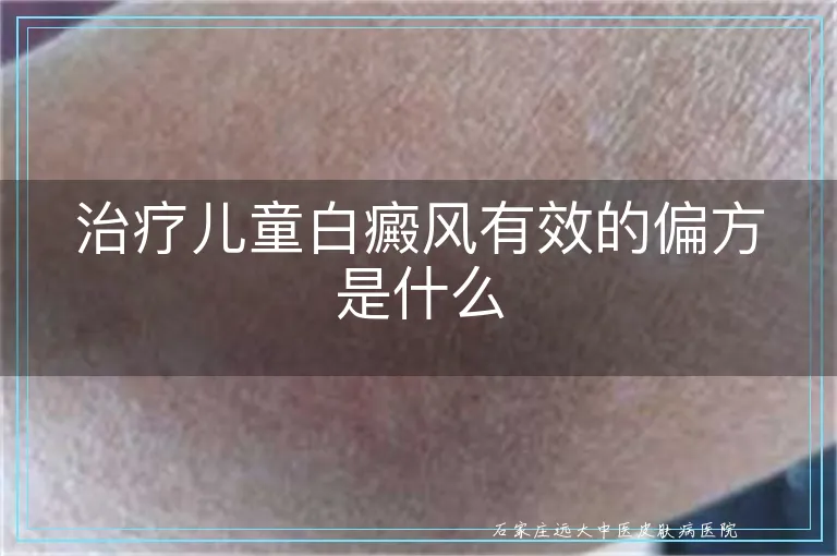 治疗儿童白癜风有效的偏方是什么
