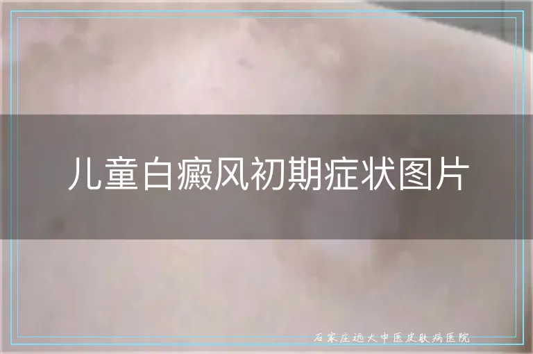 儿童白癜风初期症状图片