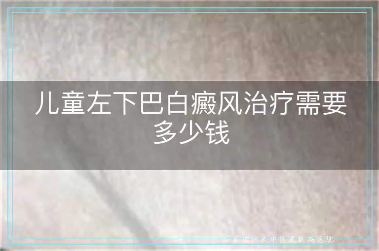 儿童左下巴白癜风治疗需要多少钱