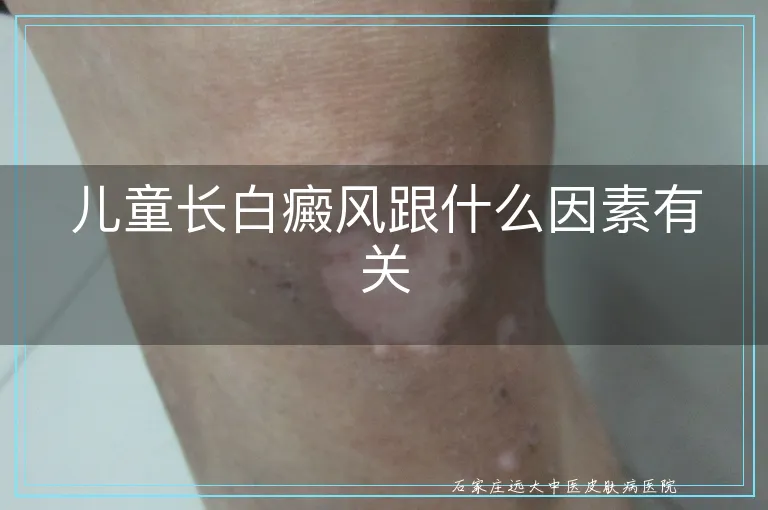 儿童长白癜风跟什么因素有关