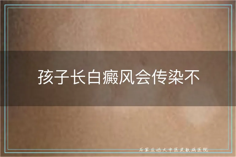 孩子长白癜风会传染不